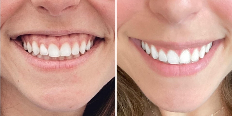 gummy smile Botulinum Toxin Type A before and after